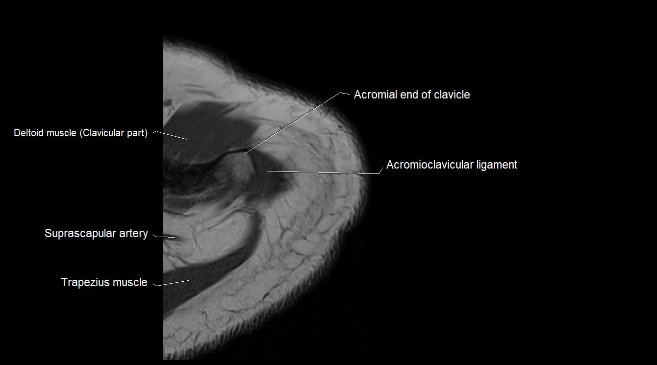Upper arm( humerus) cross section anatomy MRI 3T axial image 4.webp